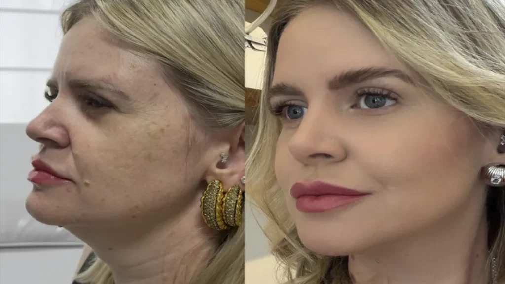 Brazil Regenerative Aesthetics Redefines Luxury Beyond Fillers